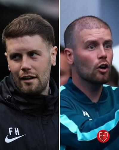 Fabian Hurzeler Hair Transplant: What the Brighton Manager Has Actually 