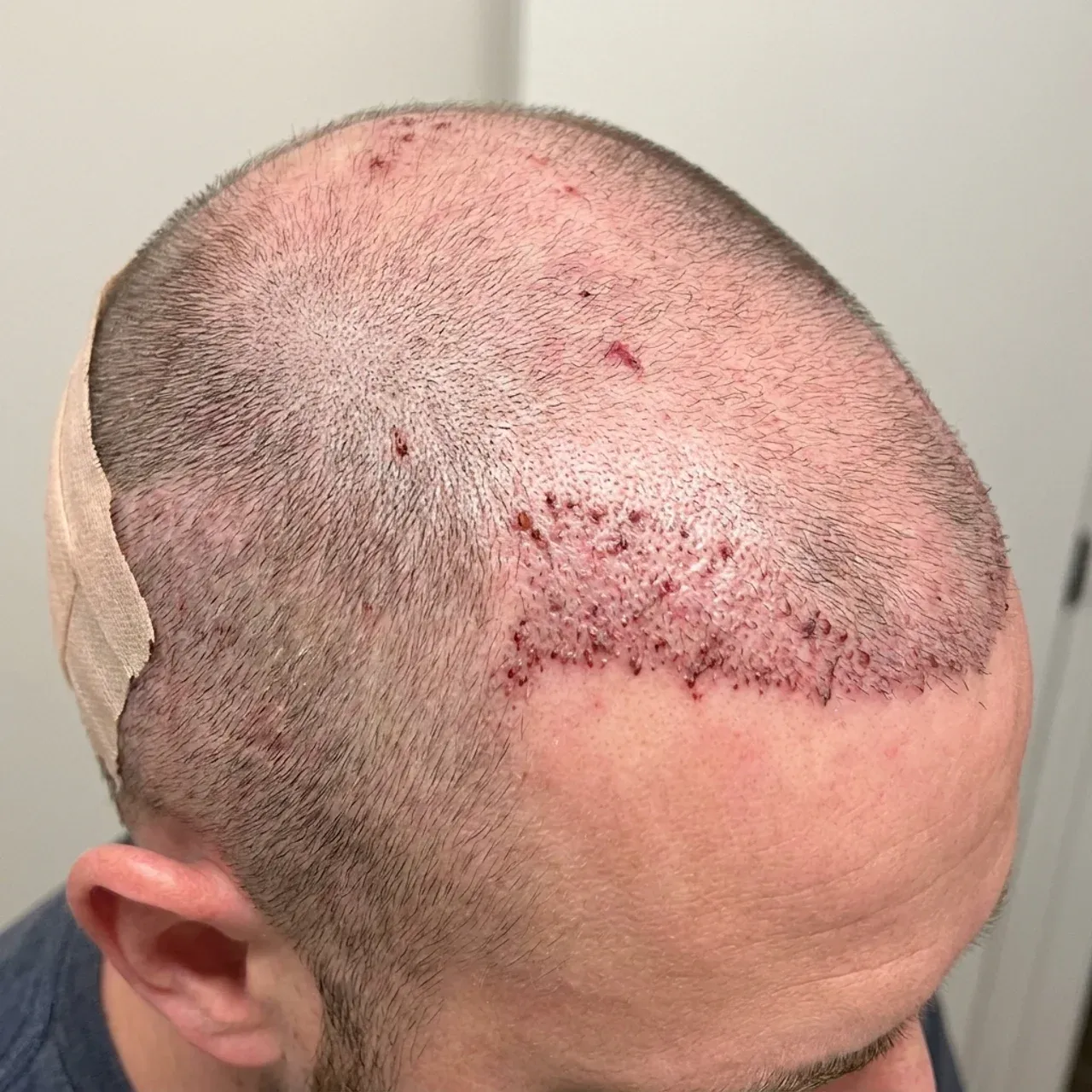 How to Hide Hair Transplant First 2 Weeks: The Ultimate Cover-Up Guide
