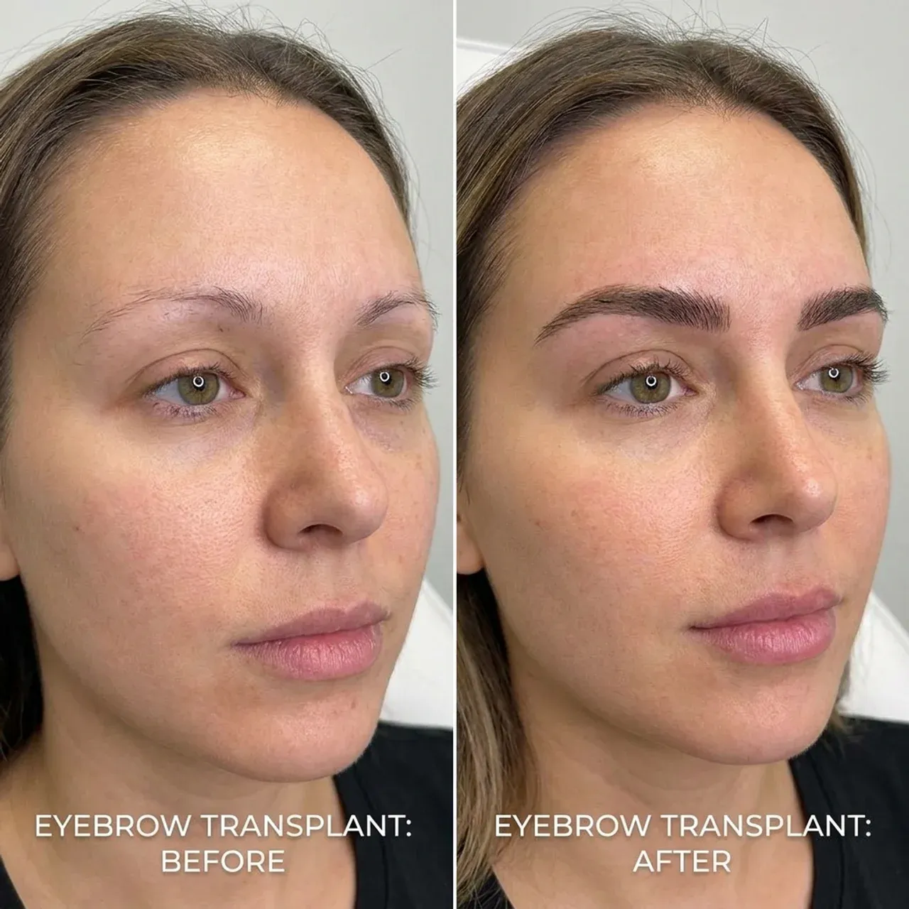 eyebrow transplant