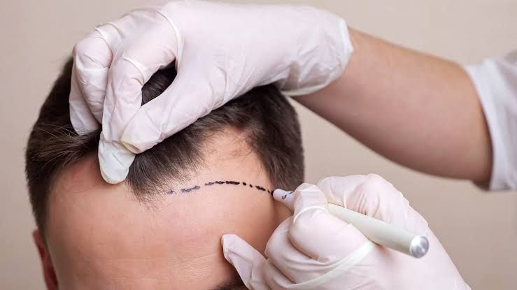 Haartransplantation Schmerzen: Wie weh tut der Weg zum vollen Haar wirklich