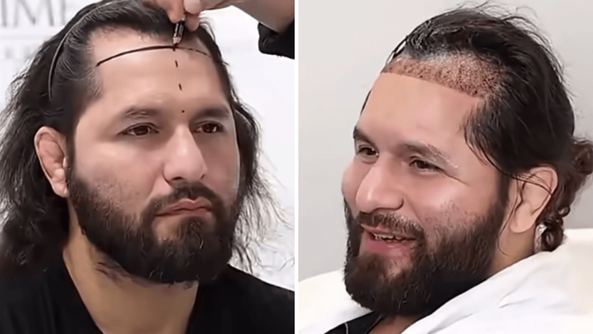  Jorge Masvidal Hair Transplant: Gamebred Goes to Turkey (April 2026)